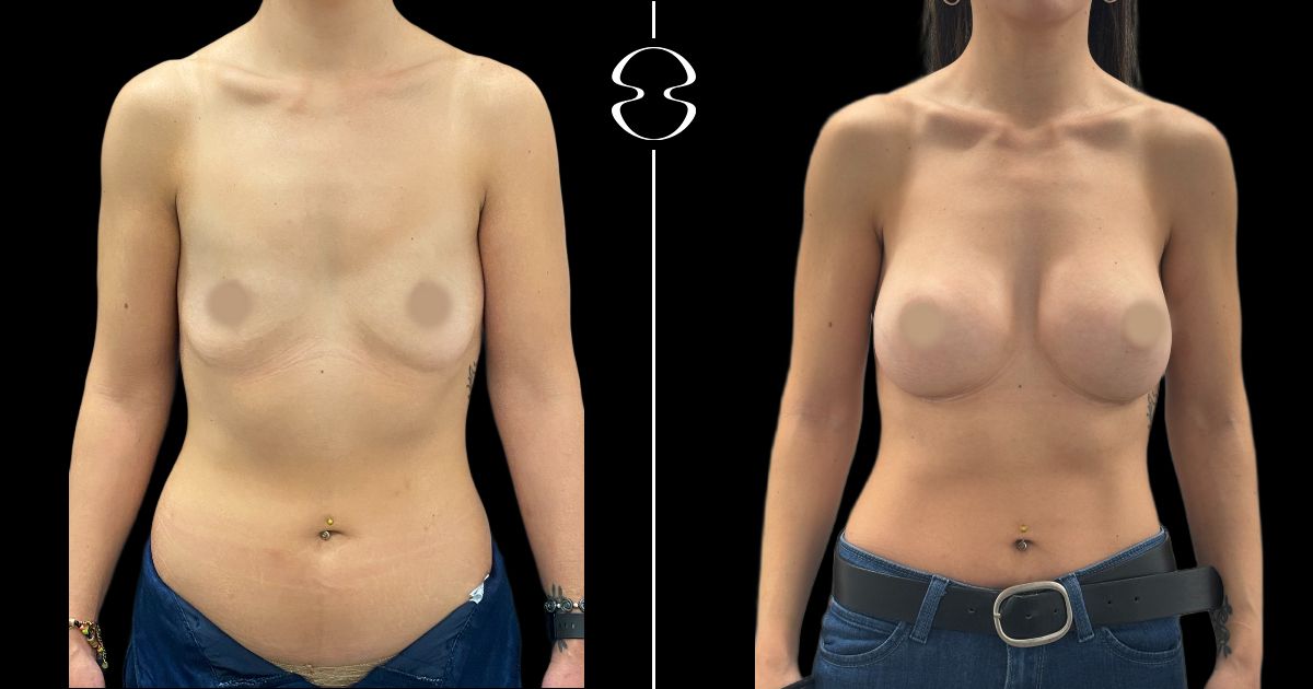 mamoplastia de aumento antes e depois