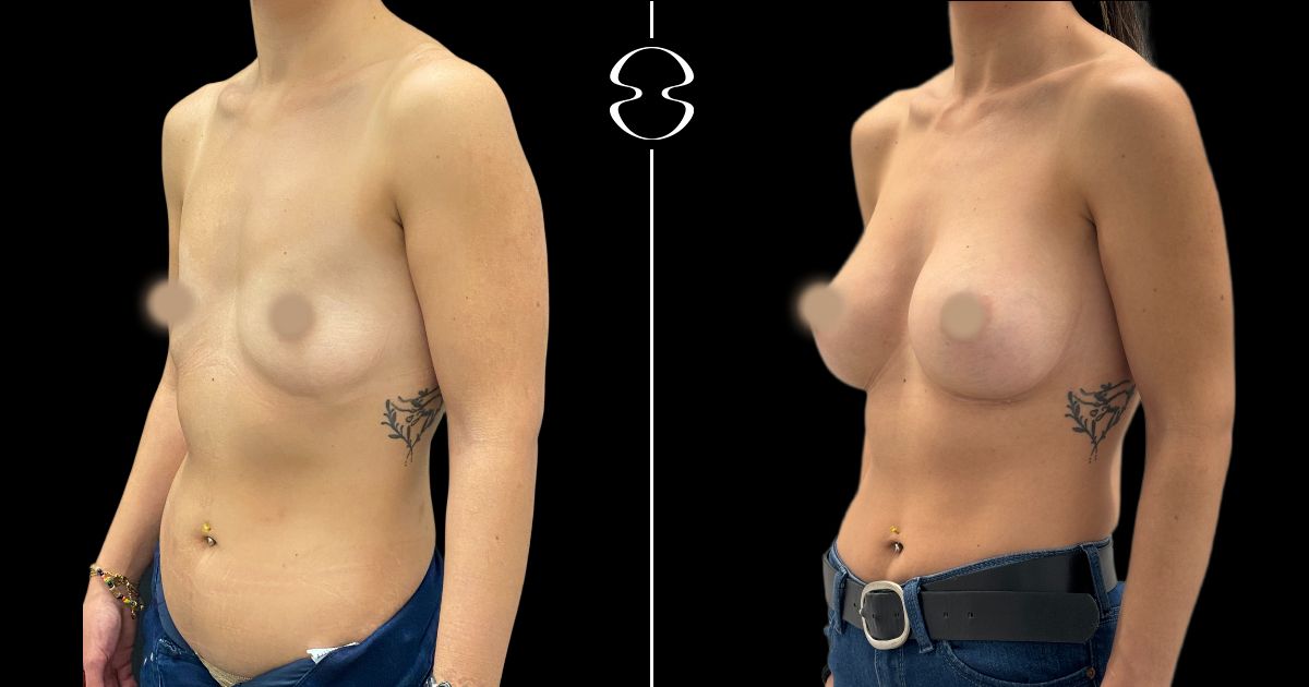 mamoplastia de aumento antes e depois