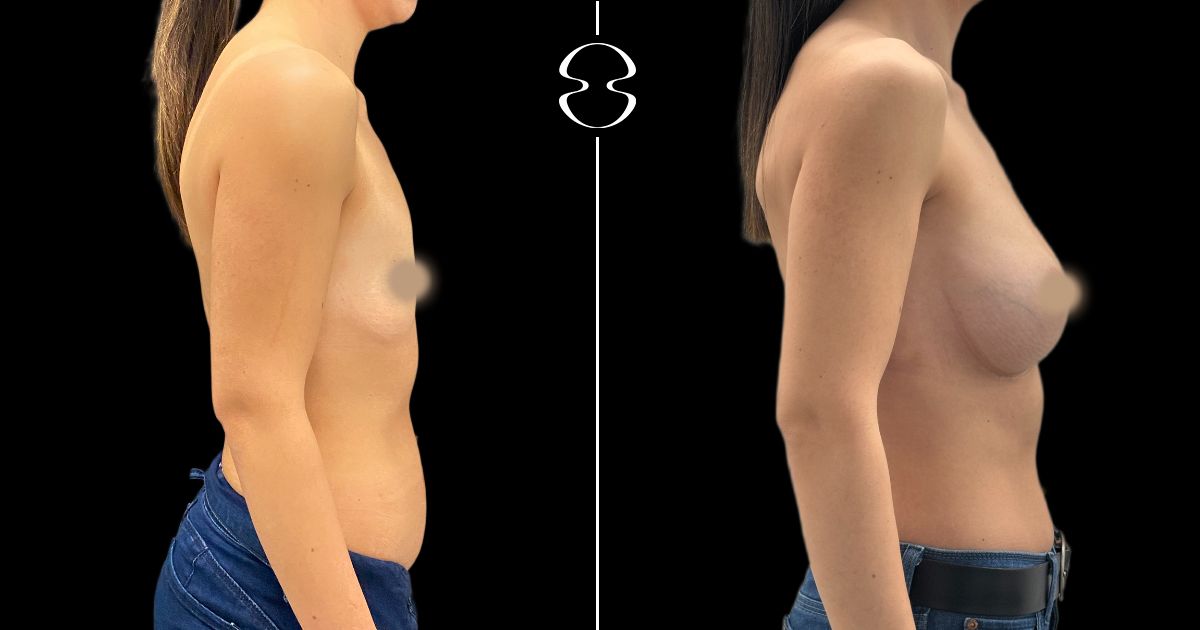 mamoplastia de aumento antes e depois