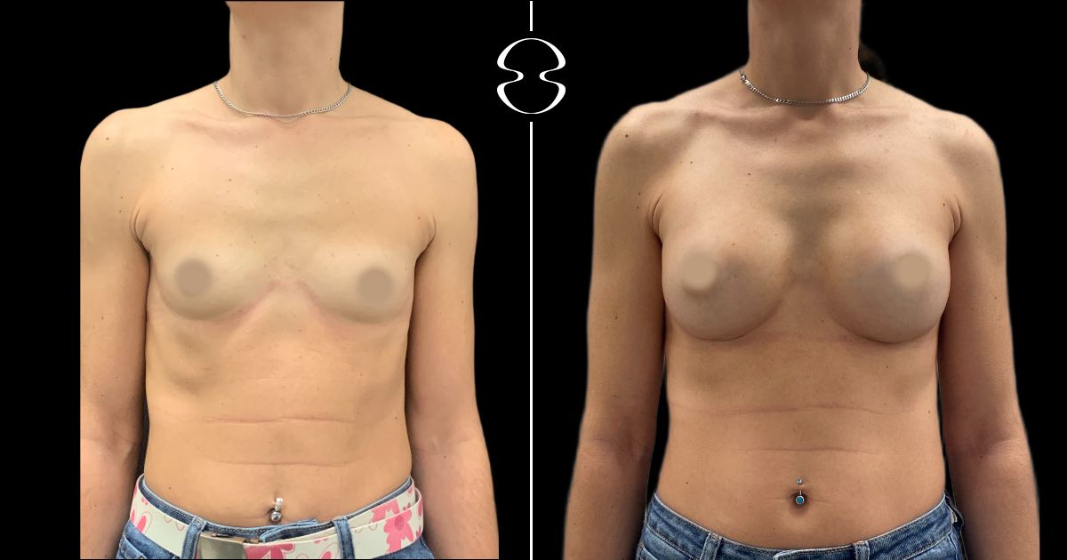 mamoplastia de aumento antes e depois