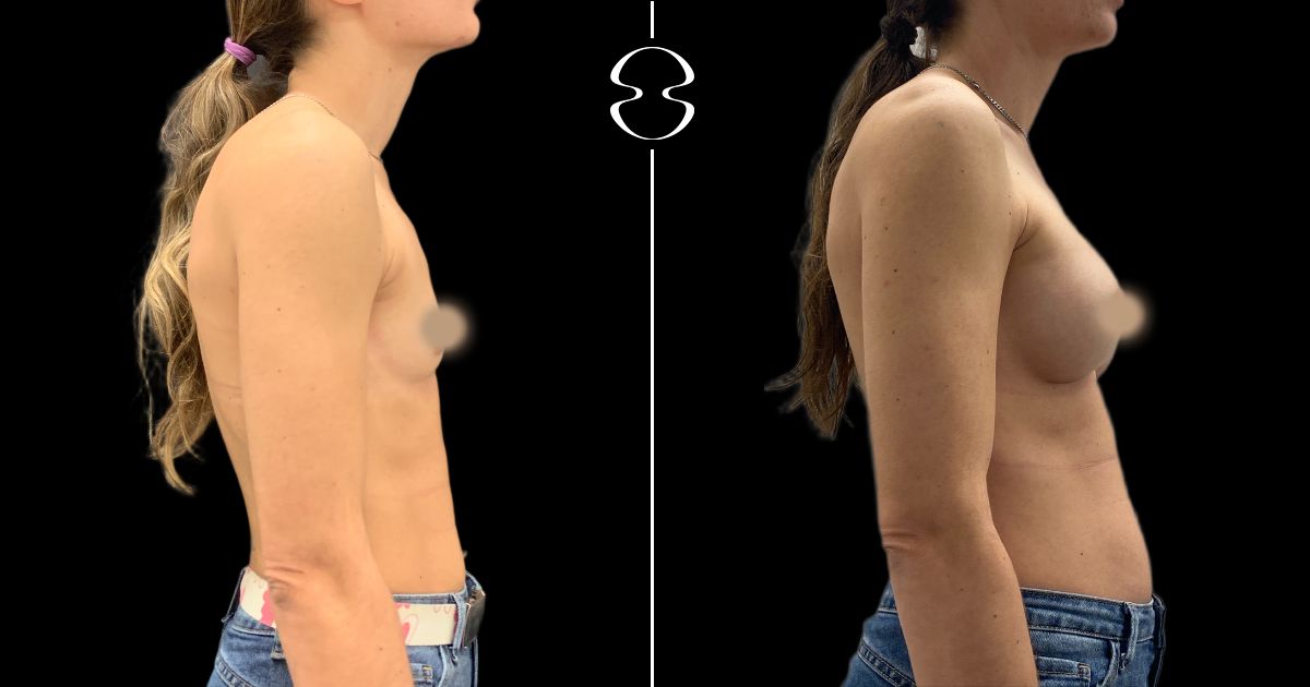 mamoplastia de aumento antes e depois