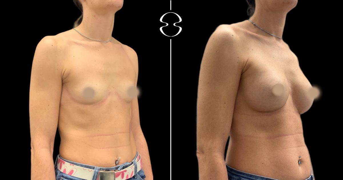 mamoplastia de aumento antes e depois