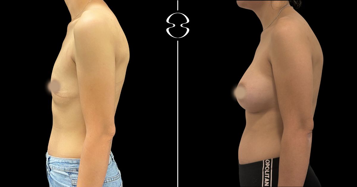 mamoplastia de aumento antes e depois
