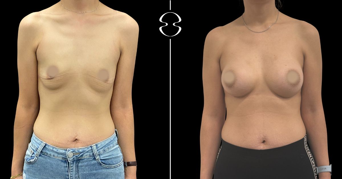 mamoplastia de aumento antes e depois