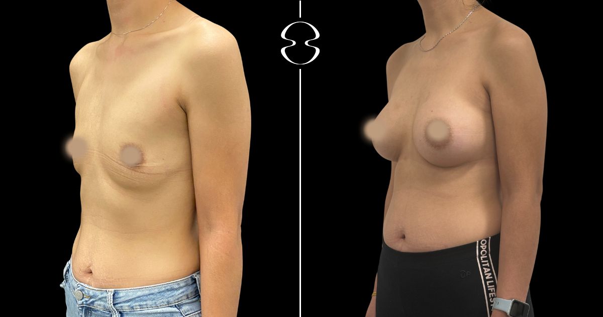 mamoplastia de aumento antes e depois
