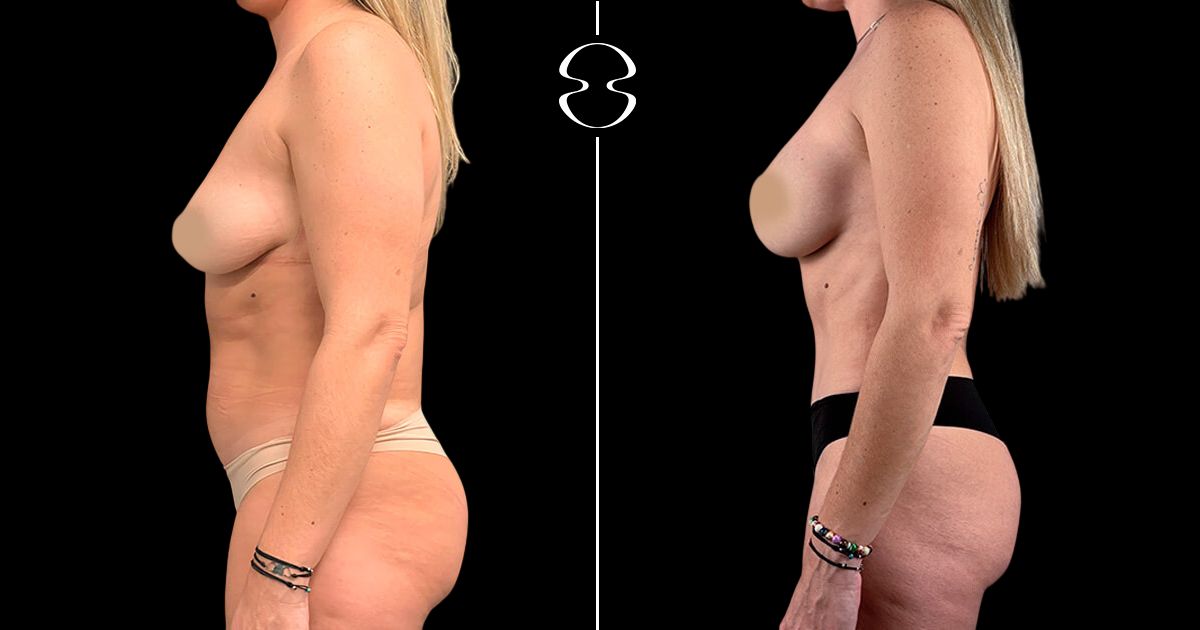mommy makeover antes e depois