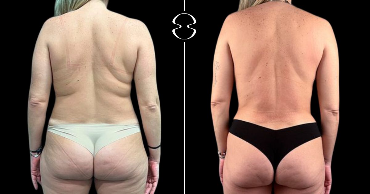 mommy makeover antes e depois