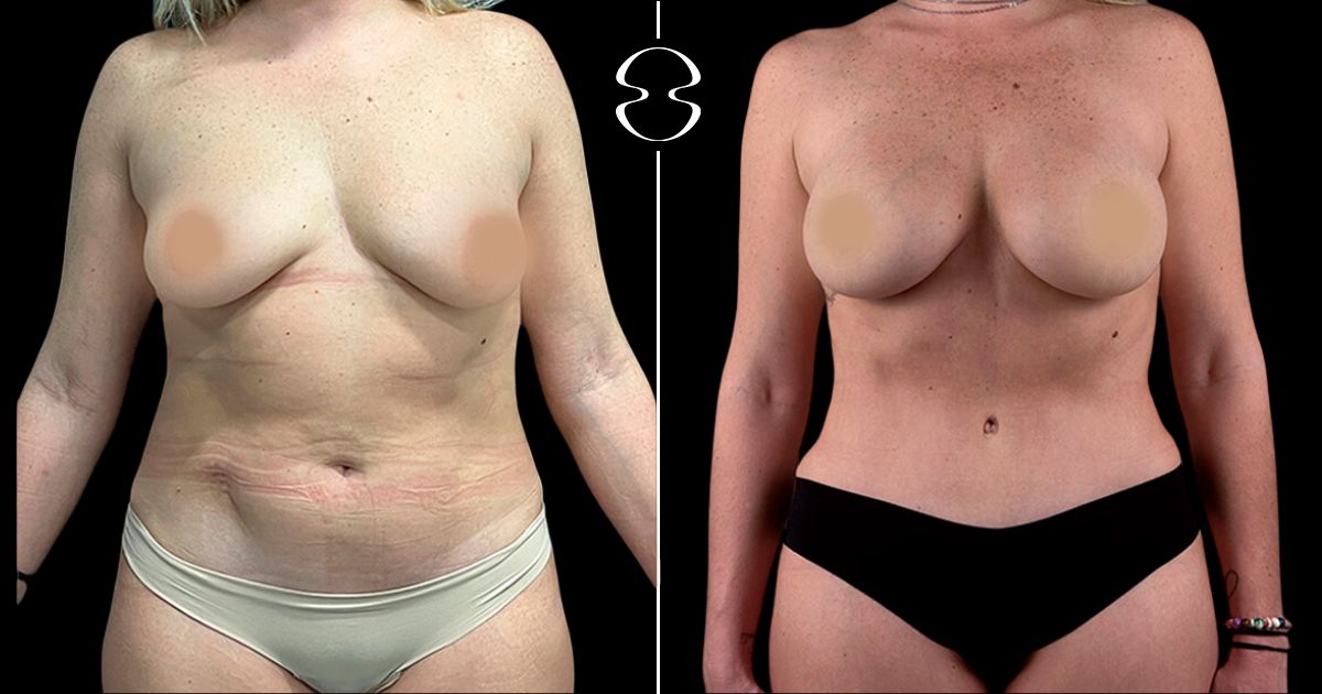 mommy makeover antes e depois