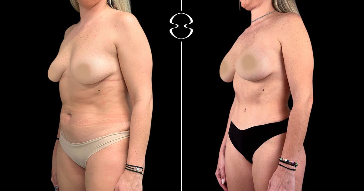 mommy makeover antes e depois
